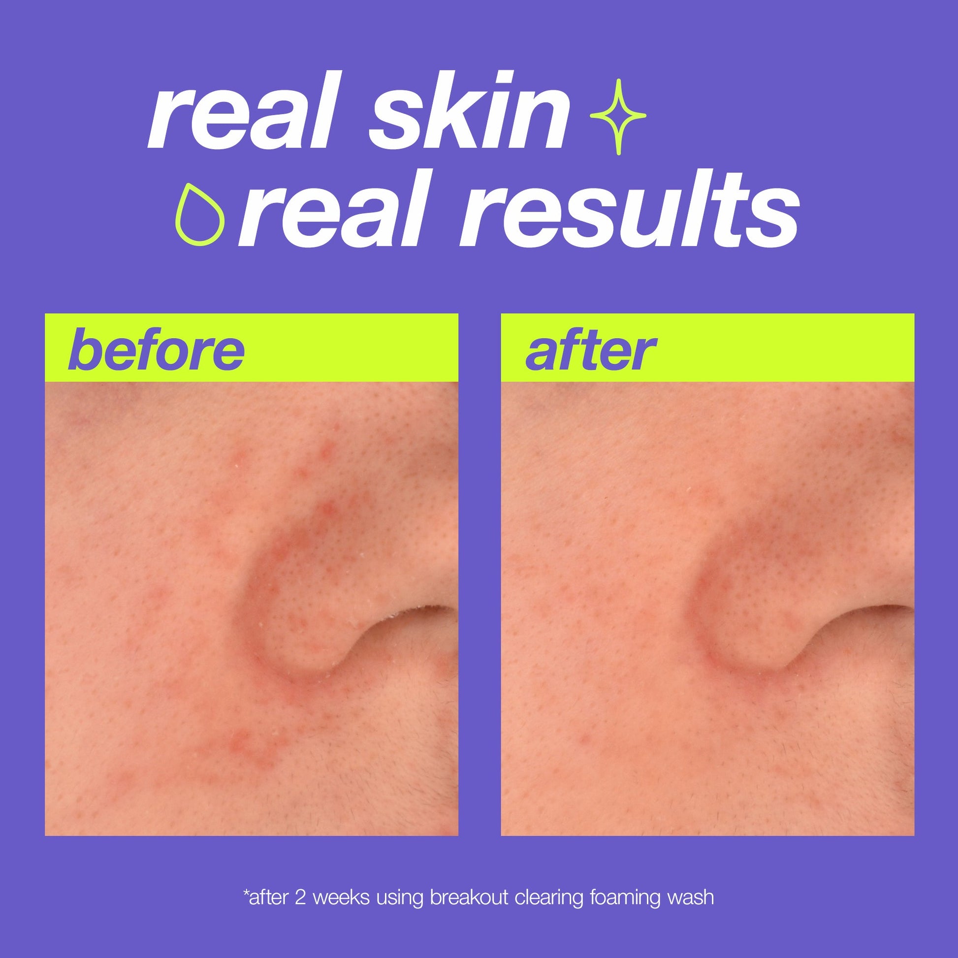 breakout clearing foaming wash real skin real results