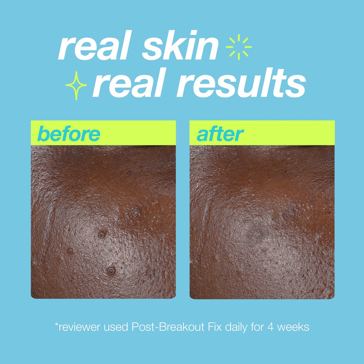 post-breakout fix real skin real results