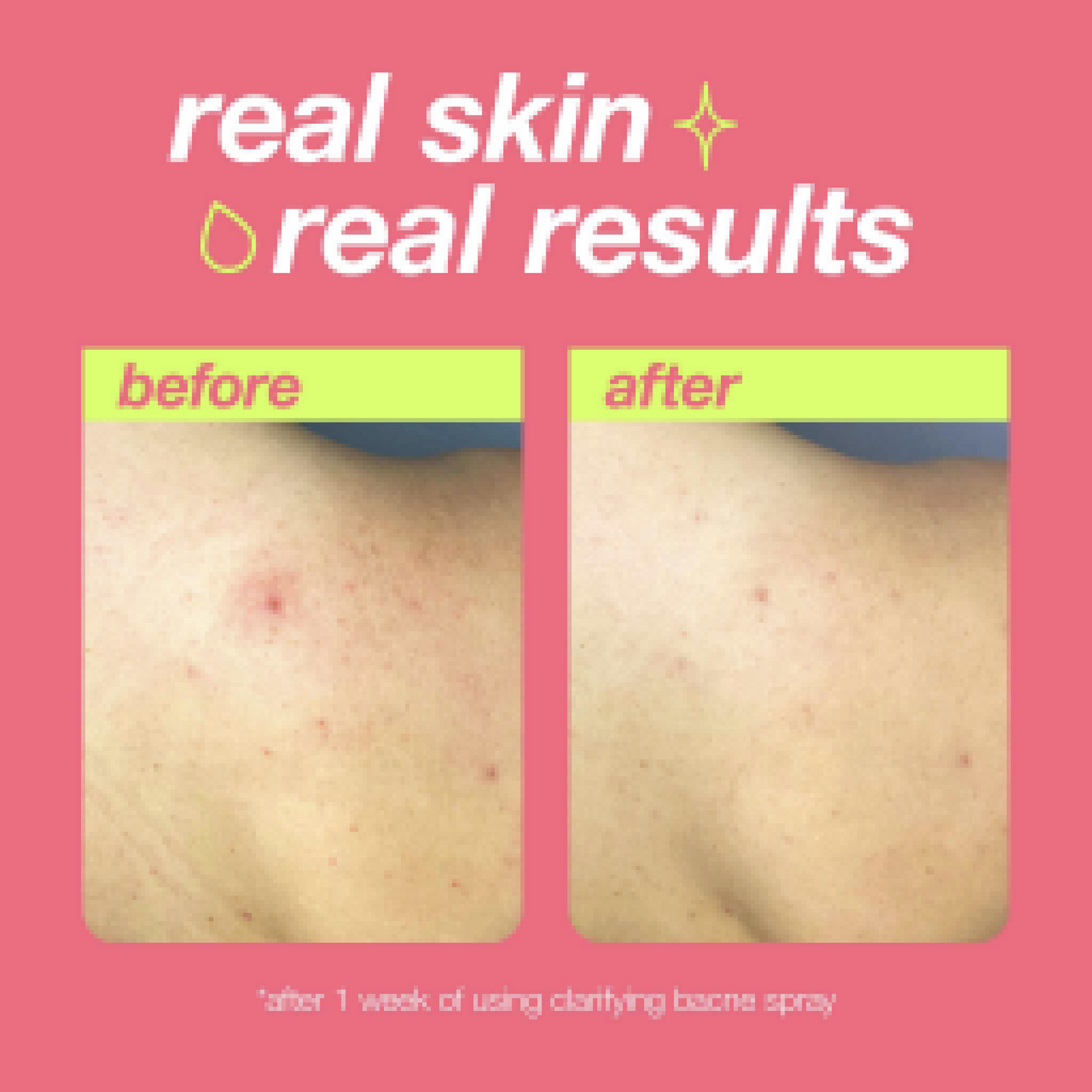 clarifying bacne spray before and after