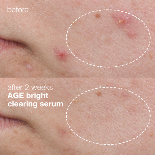 age bright clearing serum before and after 2 weeks