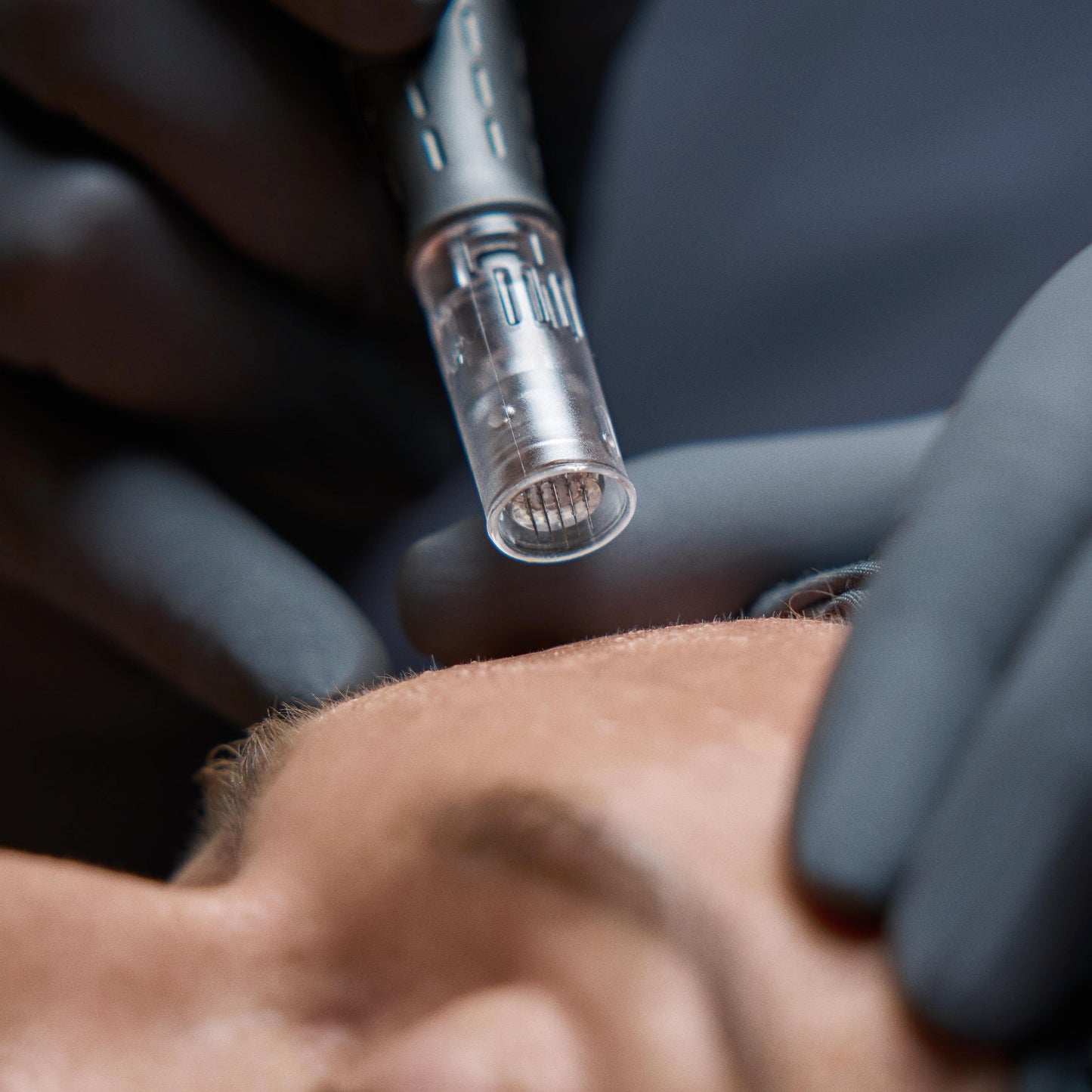 model receiving skin treatment