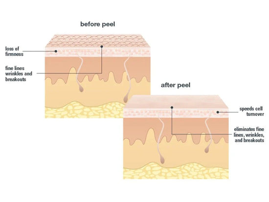 pro eye flash before peel and after peel