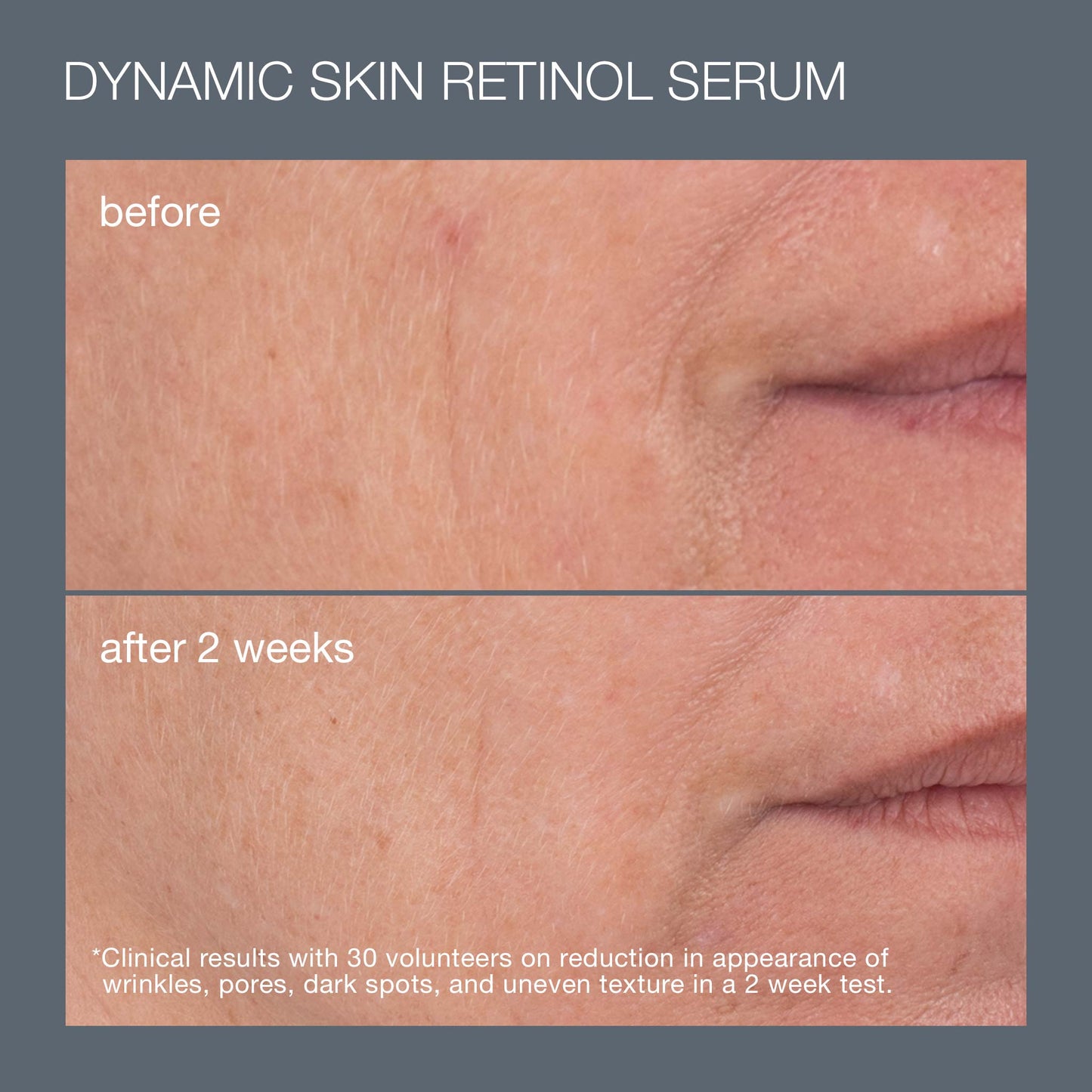before and afters of using dynamic skin retinol serum for 2 weeks