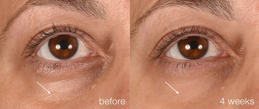 undereyes before and after 4 weeks