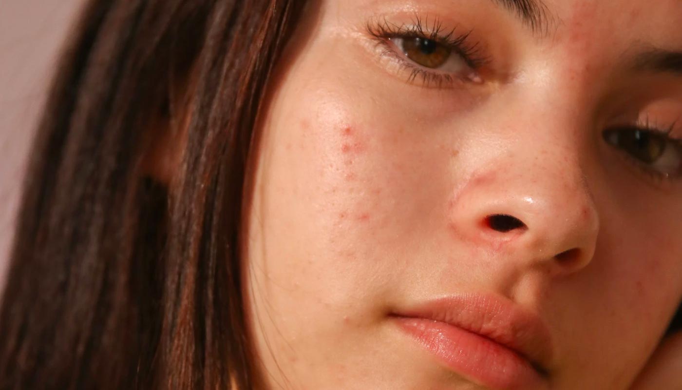 girl with teen acne