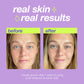 post-breakout fix real skin real results
