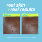 post-breakout fix real skin real results