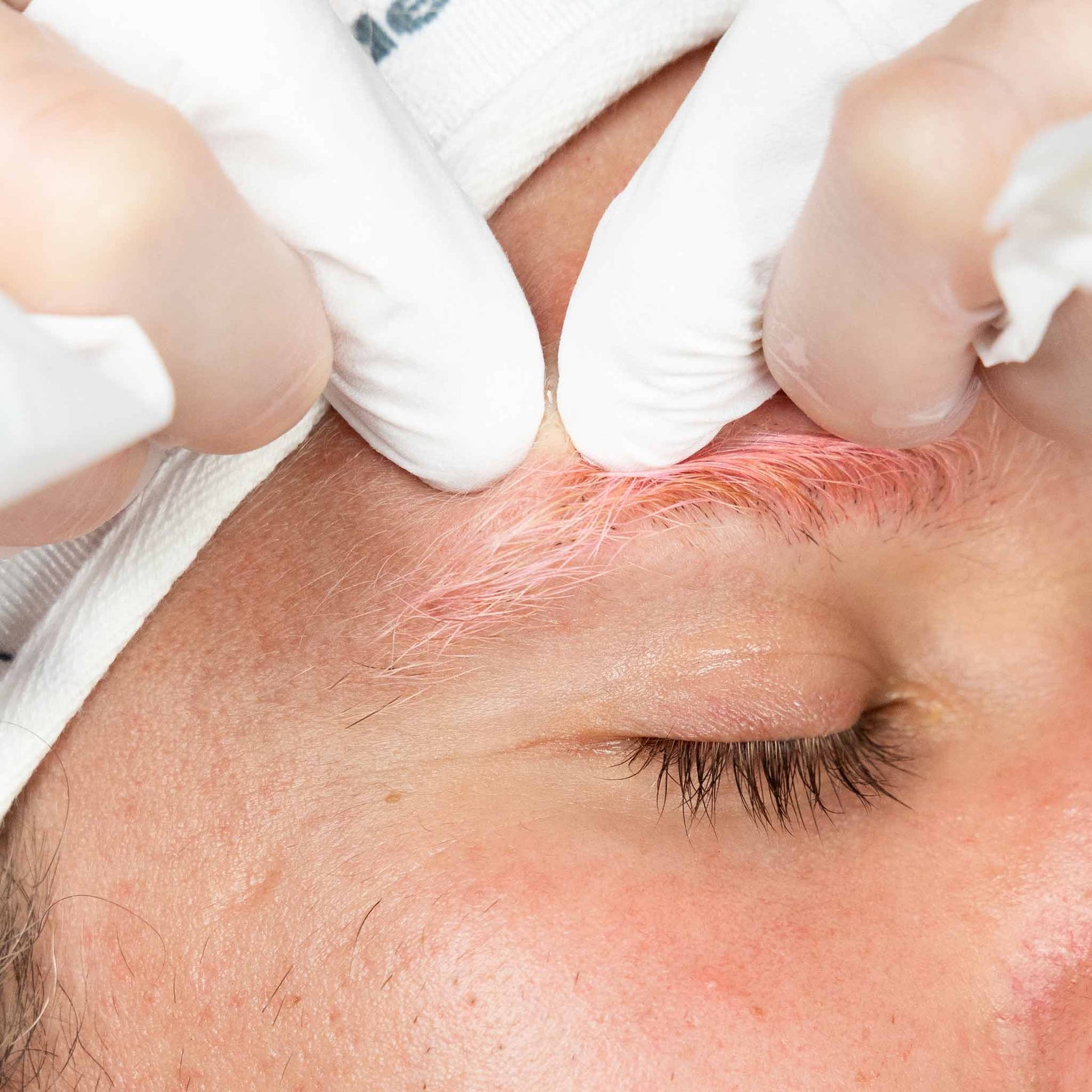 pro clear skin treatment