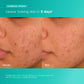 acne biotic moisturizer clinical proof