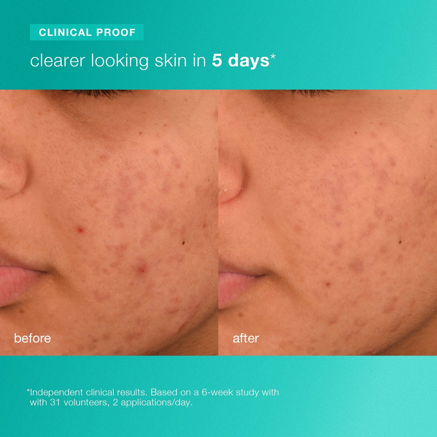 acne biotic moisturizer clinical proof 