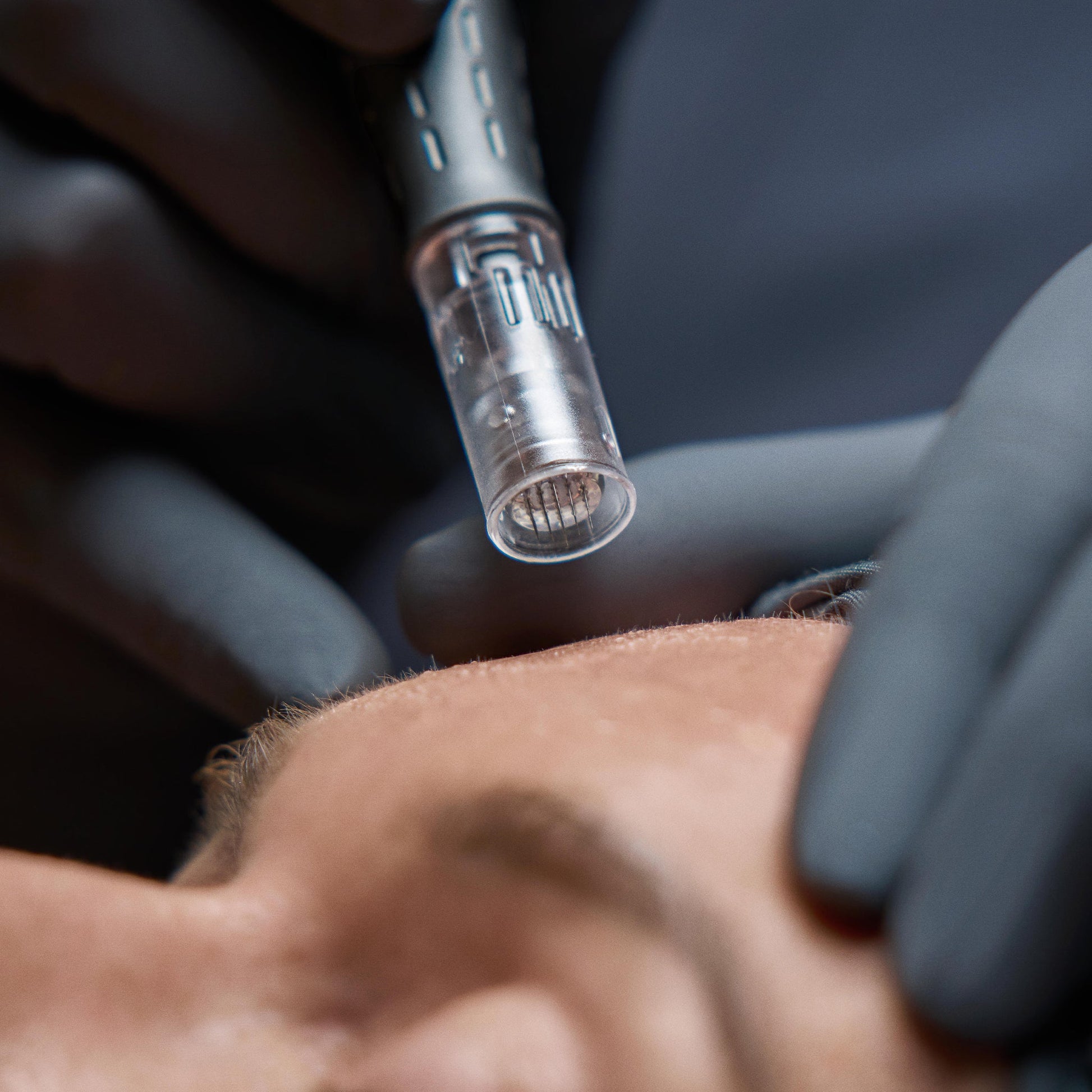 model receiving skin treatment