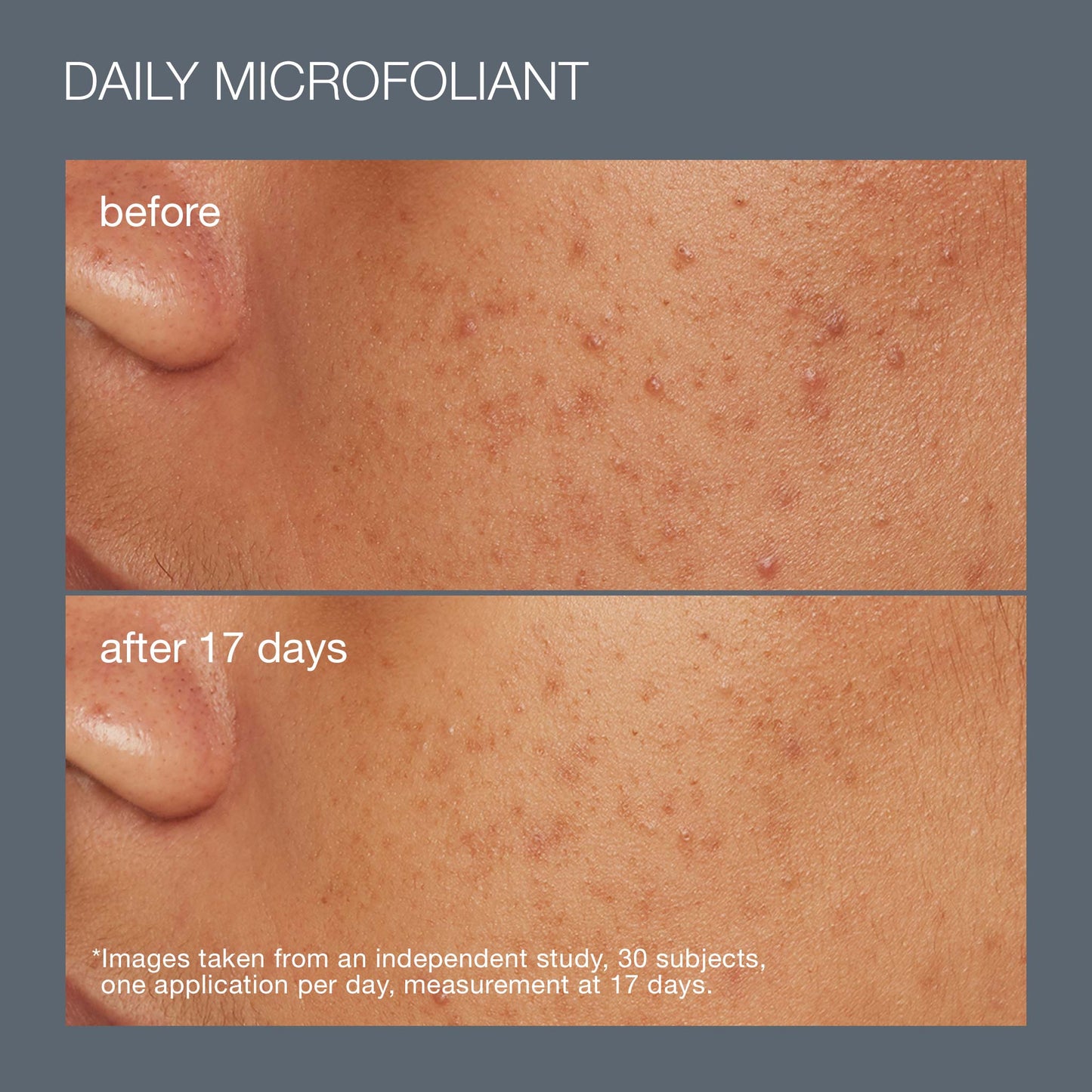 before and afters of using daily microfoliant