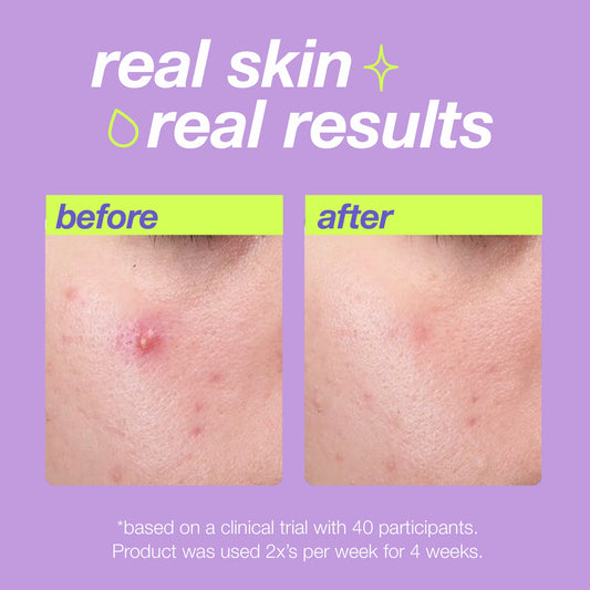 breakout clearing liquid peel benefits