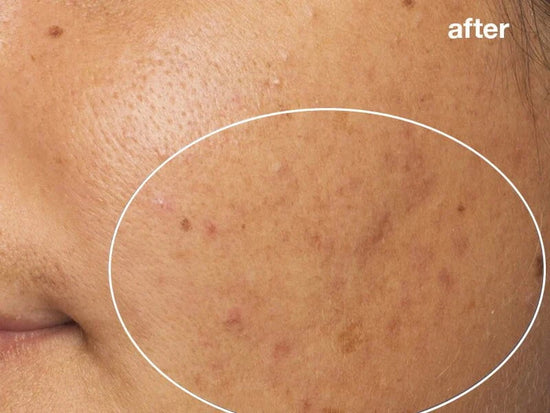 pro power peel after