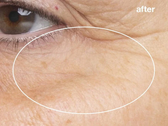 after pro power peel