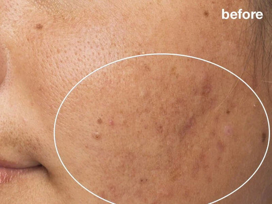 pro power peel before