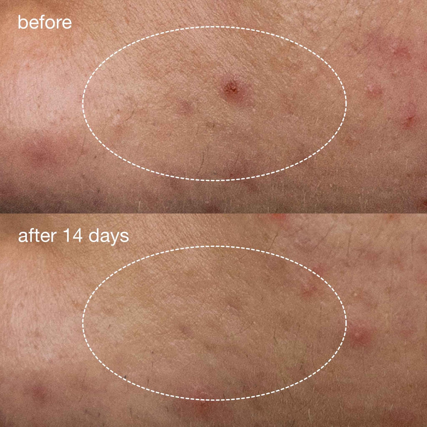 deep acne liquid patch before and after