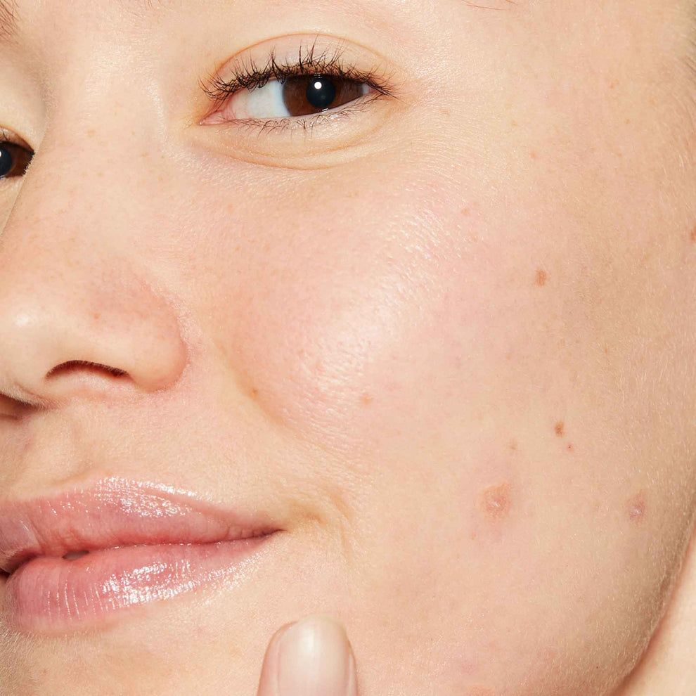 Deep Acne Liquid Patch, Invisible Sulfur Treatment with Niacinamide ...
